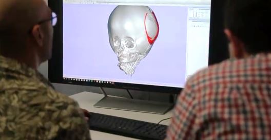A 5-year-old Georgian boy has had a unique operation after an experiment conducted on an artificial skull geotv.ge